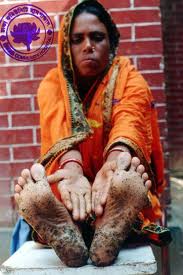 Arsenic Poisoning