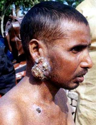 horrific effects of arsenic poisoning