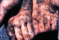 Arsenic poisoning
